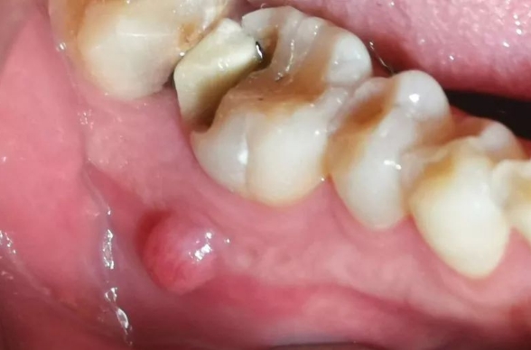 珠海鼎植口腔根尖炎